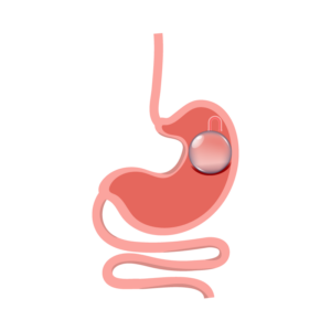 Cirugía De Balón Gástrico