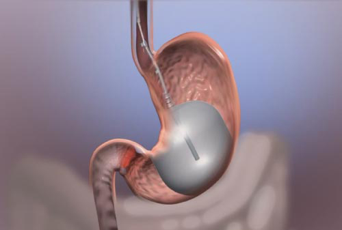 Gastric Balloon Without surgery