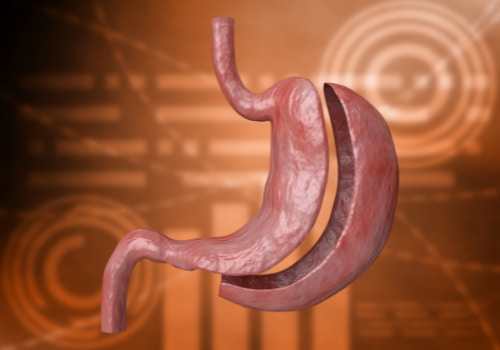 Desventaja Manga Gástrica