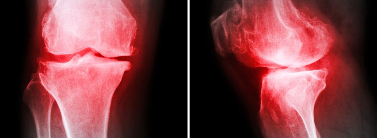 How does obesity cause osteoarthritis?