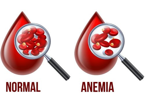 Balón gástrico y la falta de hierro
