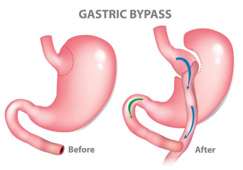 Gastric bypass surgery cost