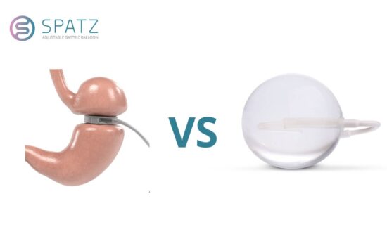 Gastric Band Surgery (LAP-Band) vs. Gastric Balloon